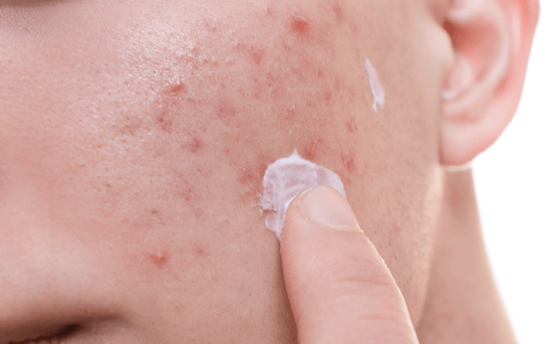 ビオチンが皮膚炎の改善に効果がある